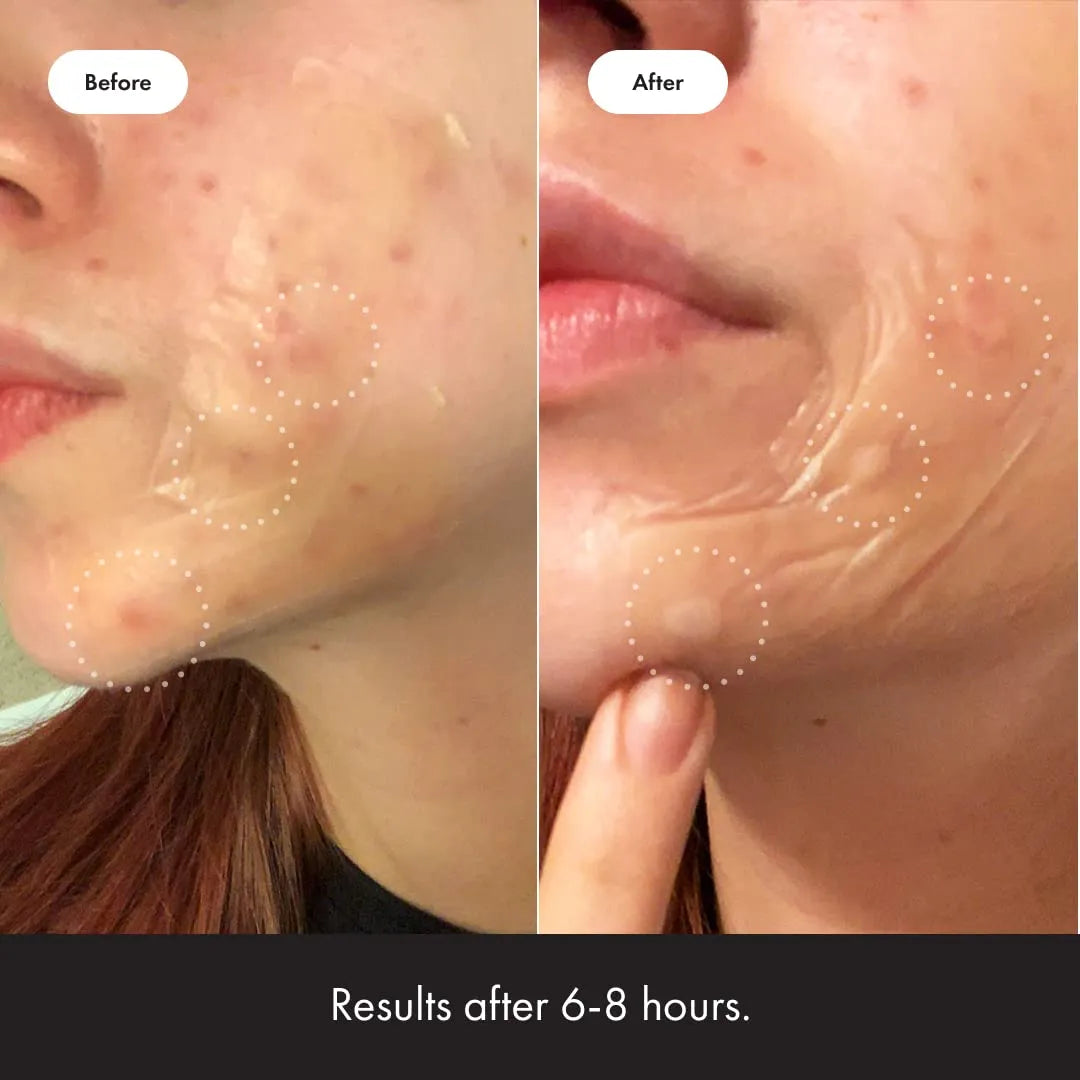 Mighty Patch Surface Large Pimple Patches for Face