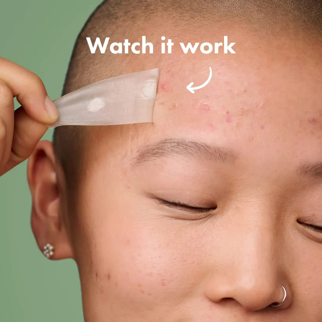 Mighty Patch Surface Large Pimple Patches for Face