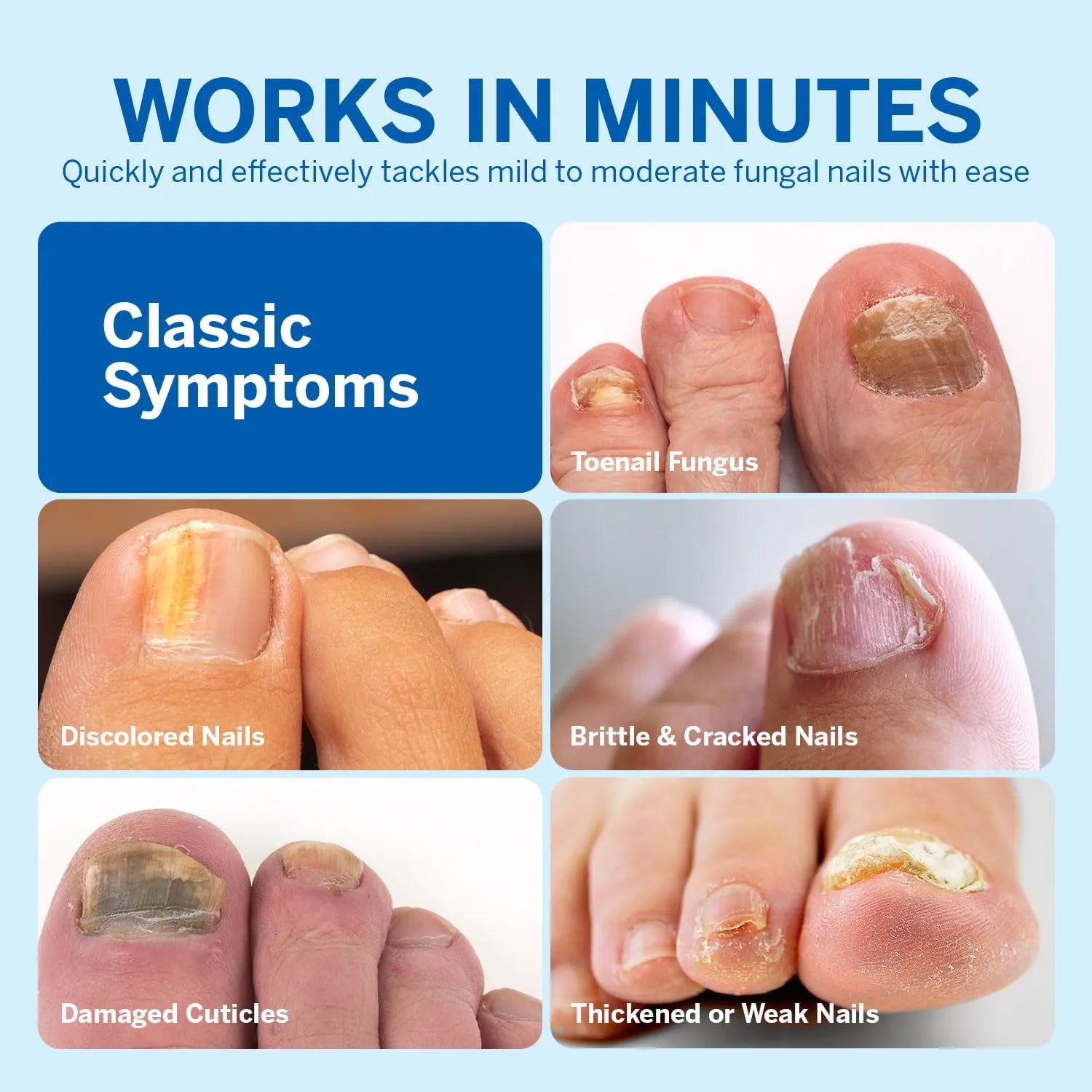Nail Fungus Treatment for Toenail