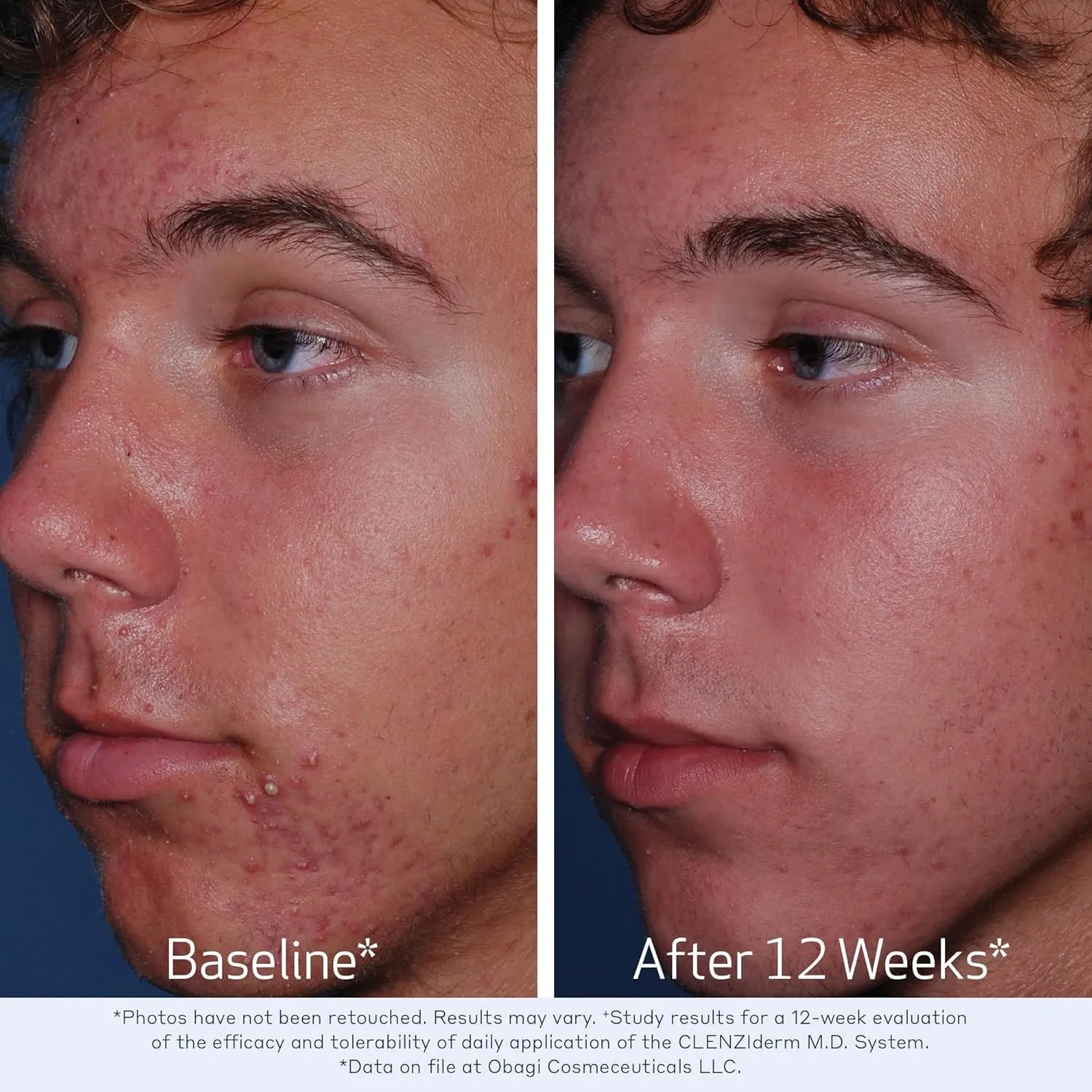 Obagi CLENZIderm M.D. Pore Therapy Exfoliating BHA Toner