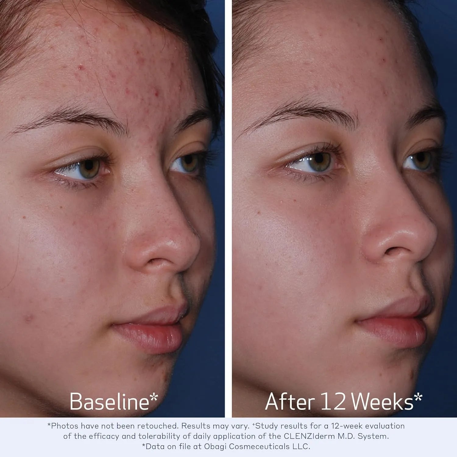 Obagi CLENZIderm M.D. Pore Therapy Exfoliating BHA Toner