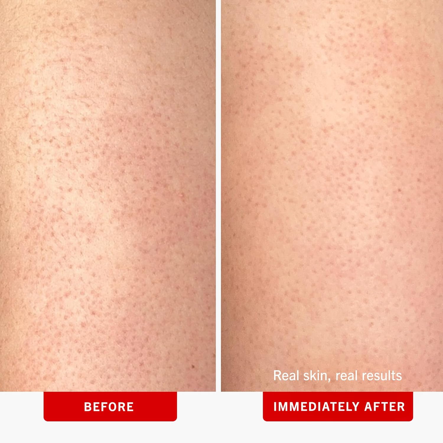 First Aid Beauty - KP Bump Eraser Body Scrub with 10% AHA Keratosis Pilaris Skin Exfoliater with Glycolic and Lactic acids Helps Reduce Chicken Skin Bumps Safe for Sensitive Skin 8 oz + Bonus 2ct