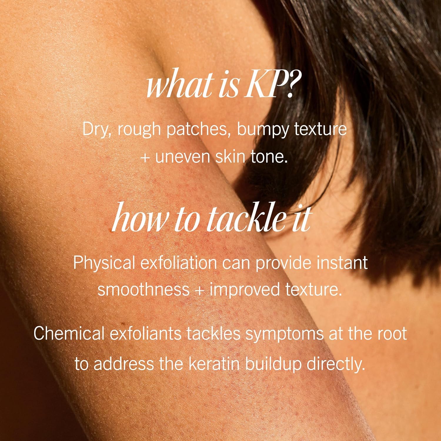 First Aid Beauty - KP Bump Eraser Body Scrub with 10% AHA Keratosis Pilaris Skin Exfoliater with Glycolic and Lactic acids Helps Reduce Chicken Skin Bumps Safe for Sensitive Skin 8 oz + Bonus 2ct