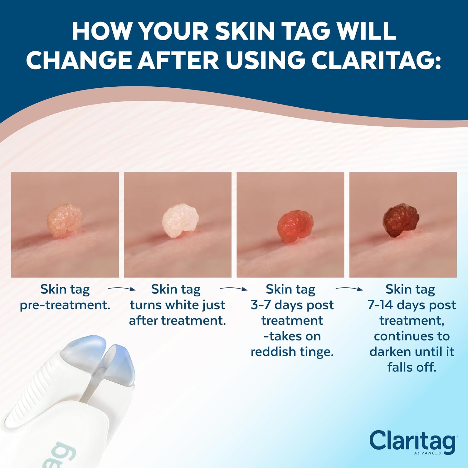 Claritag Advanced Skin Tag Remover - FDA-Cleared Device - Only for Skin Tag Removal - Works in 7-14 Days - Up to 10 Treatment Cycles - Cryogenic Freeze-Off Kit